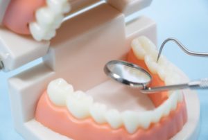 インプラントは虫歯になりますか？