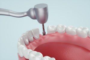 インプラント治療の成功率はどのくらいですか？