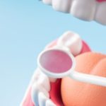 インプラントに年齢制限はありますか？