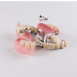 インプラントと歯の掛け橋(ブリッジ)、どちらがおすすめですか?