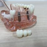 インプラント治療の手術時間はどのくらいかかりますか?