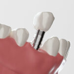 インプラント手術前の検査にはどのようなものがありますか？