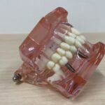 骨造成手術とは何ですか？